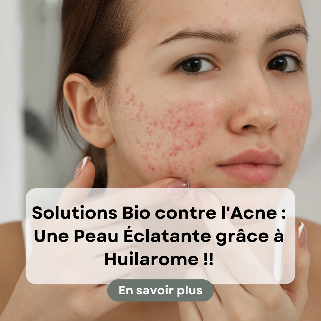 Solutions Bio contre l'Acné : Une Peau Éclatante grâce à Huilarome !!